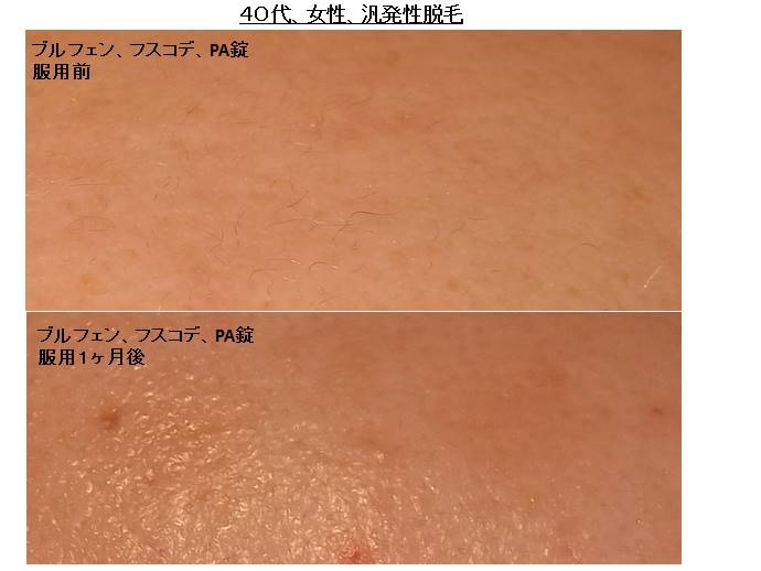 円形脱毛症　病院""
